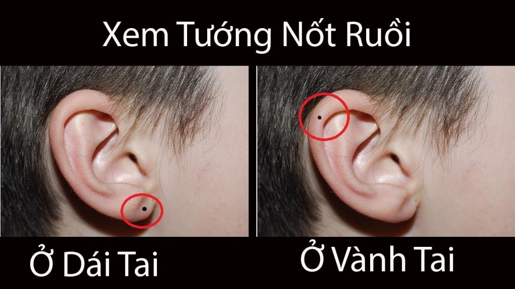 Tổng hợp ý nghĩa các vị trí nốt ruồi ở tai