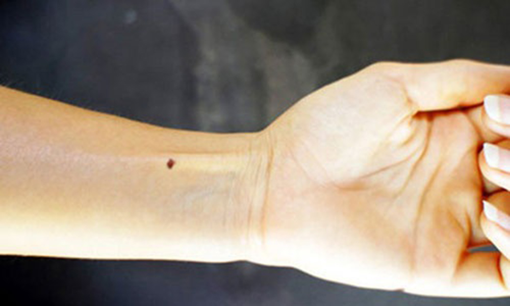 Tìm hiểu ý nghĩa nốt ruồi bắp tay trái của người phụ nữ và đàn ông nói lên điều gì