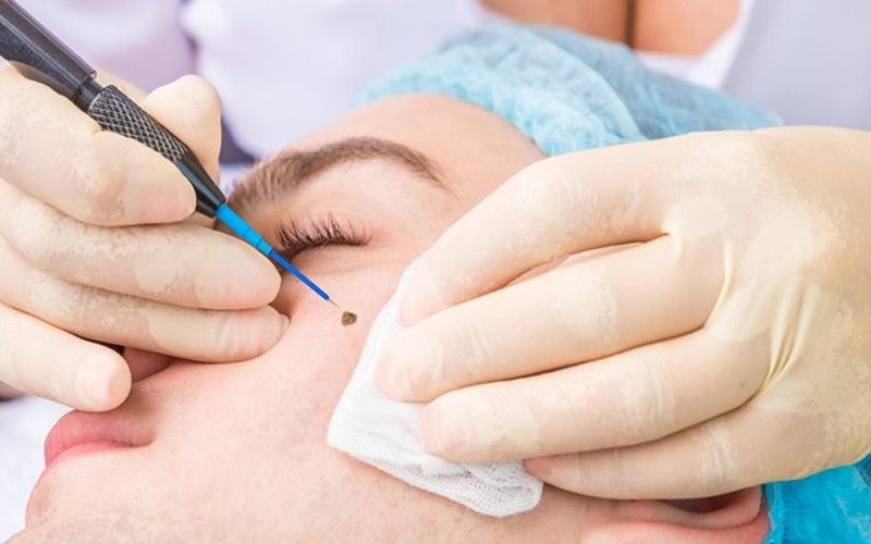 Quy trình và những điều cần lưu ý khi đốt nốt ruồi